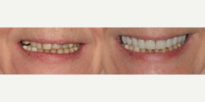 All-on-4 Dental Implants before and after photo