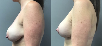 Breast Lift with Implants before and after photo