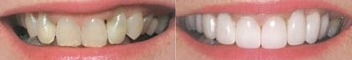 Porcelain Veneers before and after photo