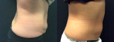 SculpSure before and after photo