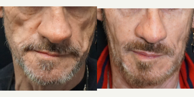 Dermal Fillers before and after photo