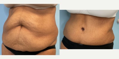 Tummy Tuck before and after photo