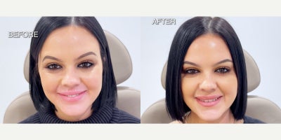 Botox before and after photo