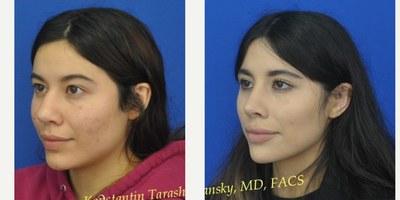 Revision Rhinoplasty before and after photo
