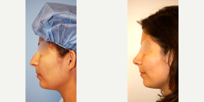 Rhinoplasty before and after photo