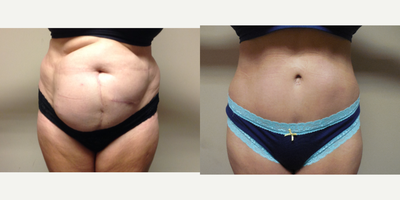 Tummy Tuck before and after photo