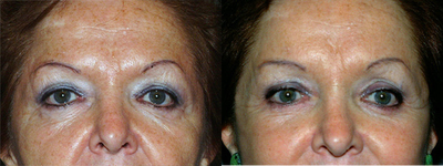 Brow Lift before and after photo