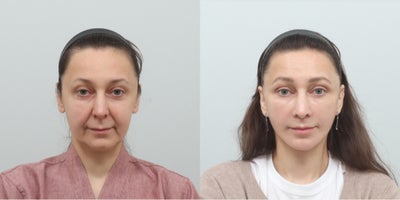 Deep Plane Facelift before and after photo