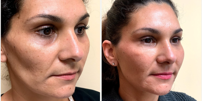Dermal Fillers before and after photo