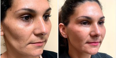 Dermal Fillers before and after photo