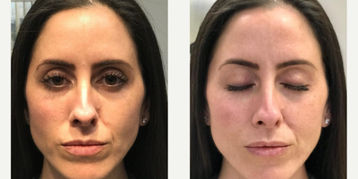Dermal Fillers before and after photo