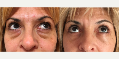 Eyelid Surgery before and after photo