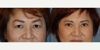 Eyelid Surgery before and after photo