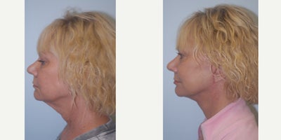 Facelift before and after photo