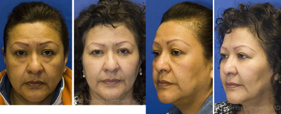 Facial Fat Transfer before and after photo