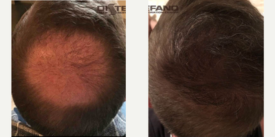FUE Hair Transplant before and after photo