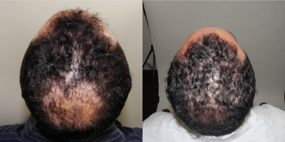 FUE Hair Transplant before and after photo