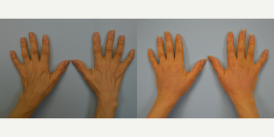 Hand Rejuvenation before and after photo