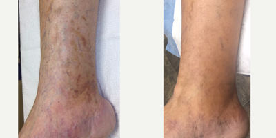 IPL before and after photo