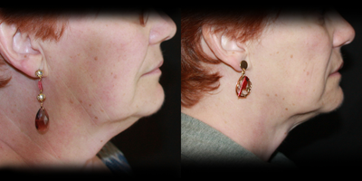 Kybella before and after photo