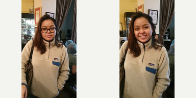 LASEK before and after photo