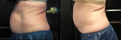 CoolSculpting before and after photo