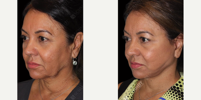 Facelift before and after photo