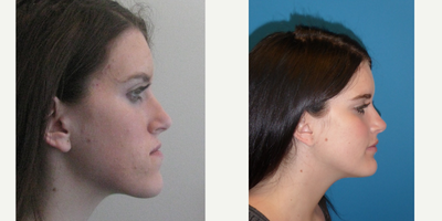 Jaw Reduction before and after photo