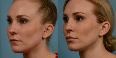 Juvederm before and after photo