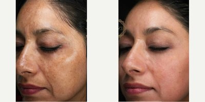 PicoSure before and after photo