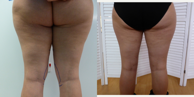 Vaser Liposuction before and after photo