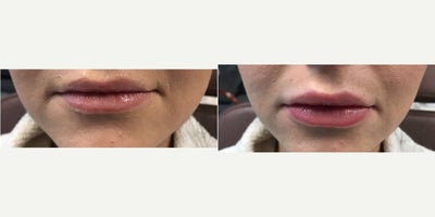 Vollure before and after photo