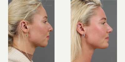 Chin Implant before and after photo