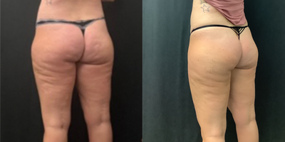 Emsculpt before and after photo