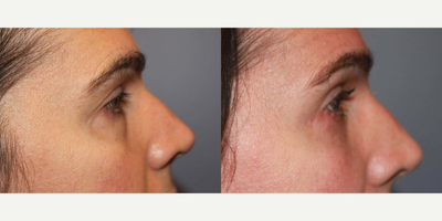 Eyelid Surgery before and after photo