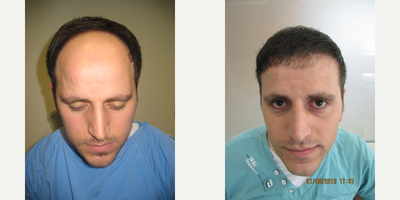 FUE Hair Transplant before and after photo