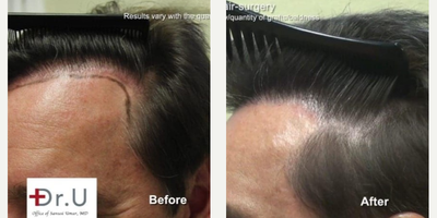Hair Transplant before and after photo