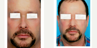 Rhinoplasty before and after photo