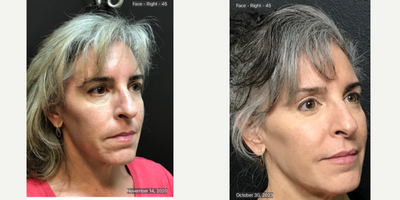 Alastin Skincare before and after photo