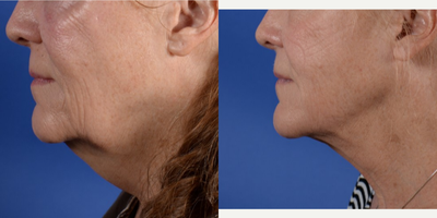 FaceTite before and after photo