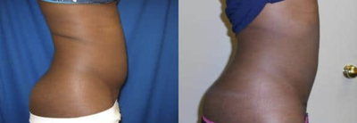Liposuction before and after photo