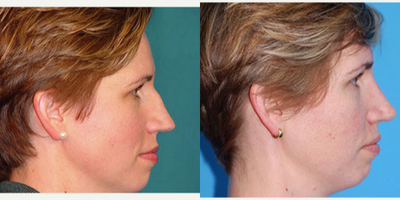 Rhinoplasty before and after photo