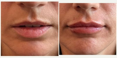 Lip Fillers before and after photo