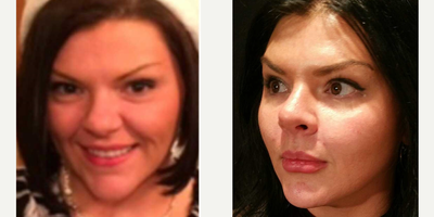 Radiesse before and after photo