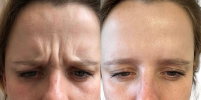 Botox before and after photo