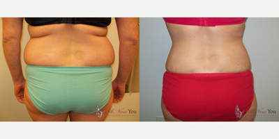 Liposuction before and after photo