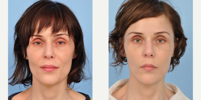 Botox before and after photo