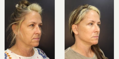Facelift before and after photo