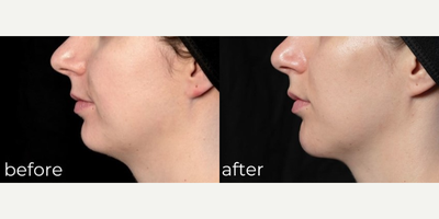 Juvederm before and after photo