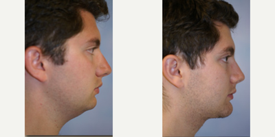 Chin Implant before and after photo